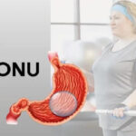 Yutulabilir Mide Balonu