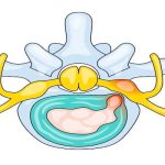 Bel Fıtığı Ameliyatı: Bilimsel Verilerle Karar Süreci