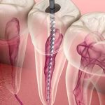 Kanal Tedavisi Nedir