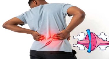 Bacaklarda Uyuşma Dar Kanal Belirtisi Olabilir mi?