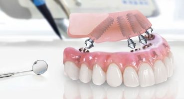 Diş Protezi Nedir?